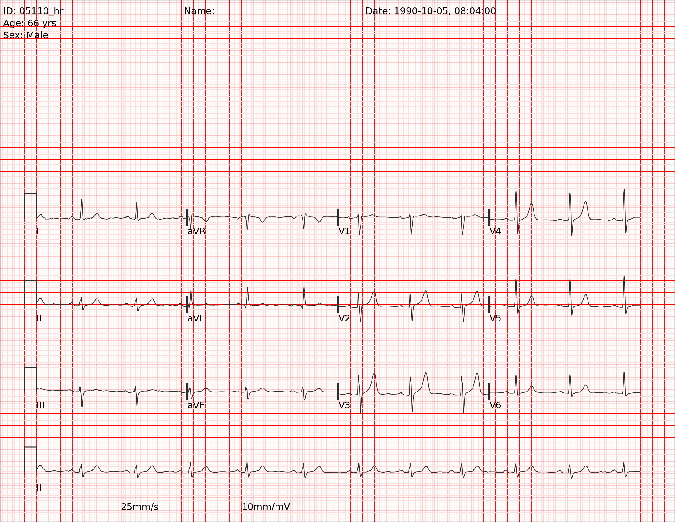 The sample EKG we will analyze